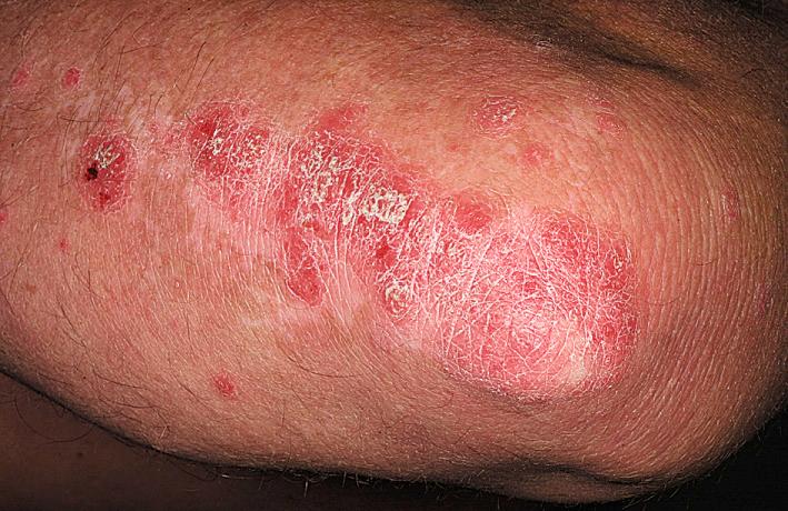 Fig. 5.30, Inflammatory plaque psoriasis. This plaque has partially responded to clobetasol cream. Topical steroids usually do not clear a plaque completely, and the disease typically returns after topical application is stopped.