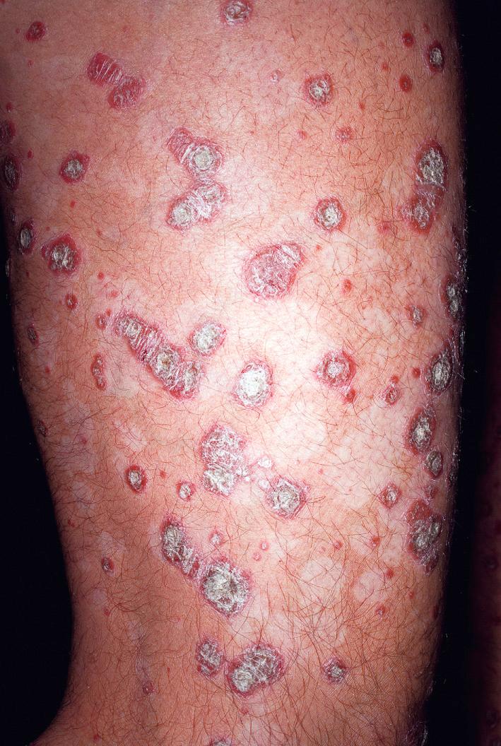 Fig. 5.3, Psoriasis. Extensive small chronic plaques with thick scaling on the lower leg. Note the interspersed areas of postinflammatory hypopigmentation of previously treated psoriasis plaques.