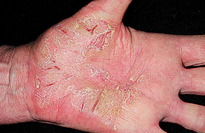 Fig. 5.31, Inflammatory plaque psoriasis. Chronic inflammation of the palms is a difficult diagnostic problem. Psoriasis and eczema may have a similar appearance. Both are difficult to treat.