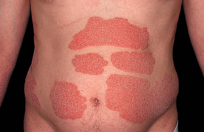 Fig. 5.32, Chronic plaque psoriasis may be asymptomatic. This patient was not uncomfortable and became discouraged with topical treatments. He was satisfied with using just moisturizers.