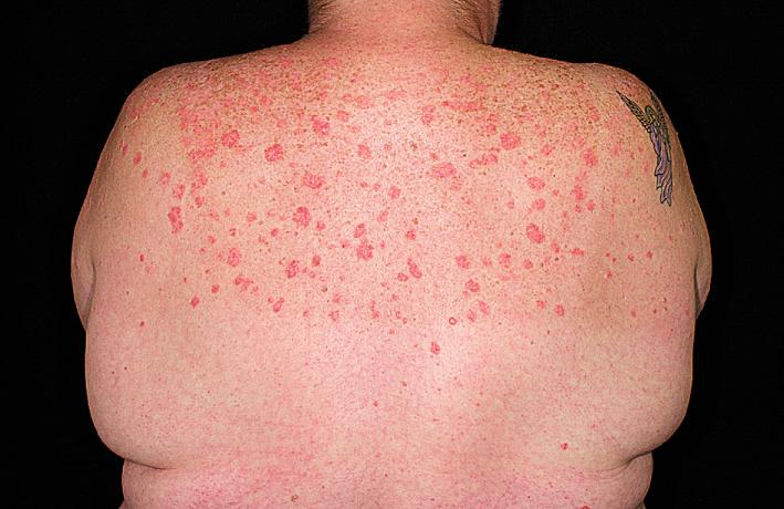 Fig. 5.33, Chronic plaque psoriasis. Gentle sunlight is an effective treatment. Sunburn can initiate a psoriatic flare.