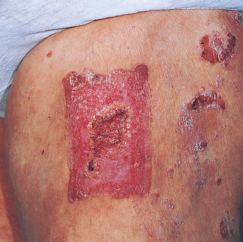 Fig. 5.34, Psoriasis can occur at site of trauma (Koebner's phenomenon). This is psoriasis occurring on the donor site of a skin graft.