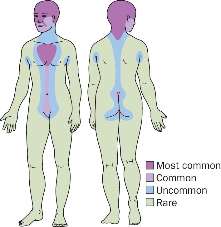 Fig. 5.35, Seborrheic dermatitis distribution diagram.