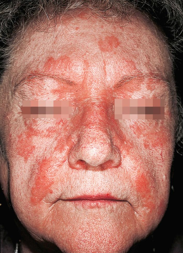 Fig. 5.36, Seborrheic dermatitis. Erythema and scaling may be extensive and extend beyond the nasolabial folds.