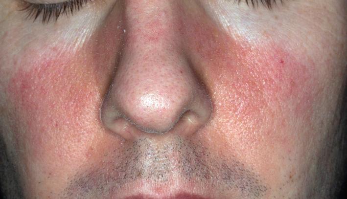 Fig. 5.37, The rash may extend beyond the nasolabial folds to involve the cheek.