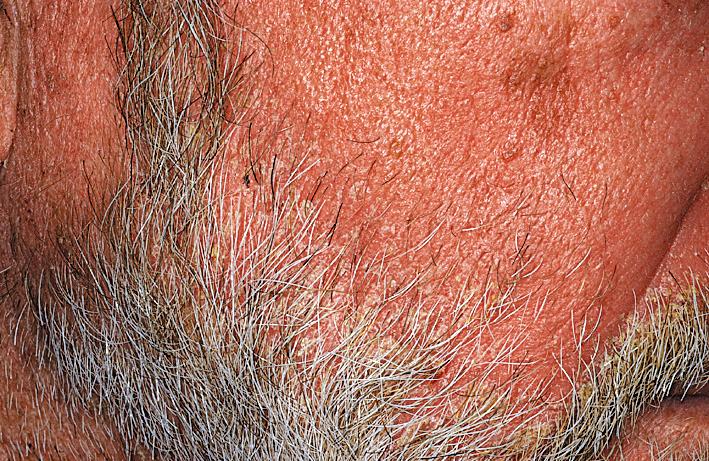 Fig. 5.39, Seborrheic dermatitis. Patients with a propensity to develop seborrheic dermatitis will develop erythema and scale if they grow a beard. The disease will often clear if the hair is shaved.