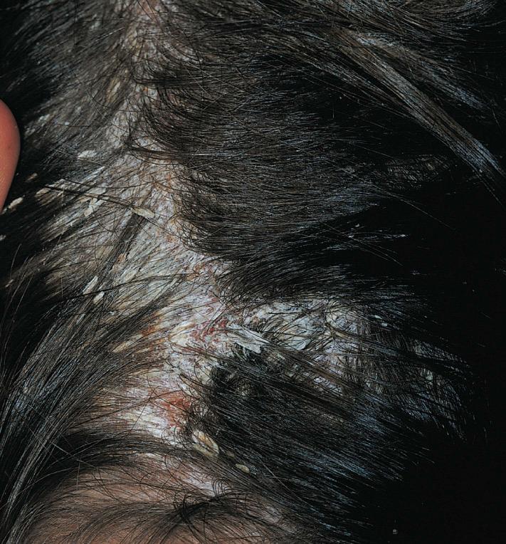 Fig. 5.40, Seborrheic dermatitis. Dense patches of quadrangular scale occur in children. The scale adheres to the hair (tinea amiantacea). Scale should be gently removed with olive oil; vigorous removal may result in permanent hair loss.