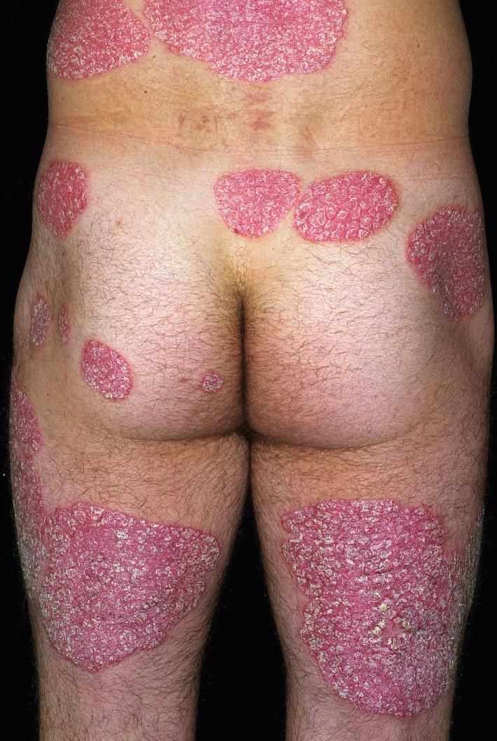 Fig. 5.4, Psoriasis. Larger chronic plaques coalescing into geographic plaques. Such involvement responds well to ultraviolet light therapy.