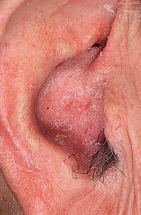 Fig. 5.41, Seborrheic dermatitis of the ears usually requires group V topical steroids for control. Patients should pay special attention to drying the ears after bathing because moisture will flare seborrheic dermatitis.