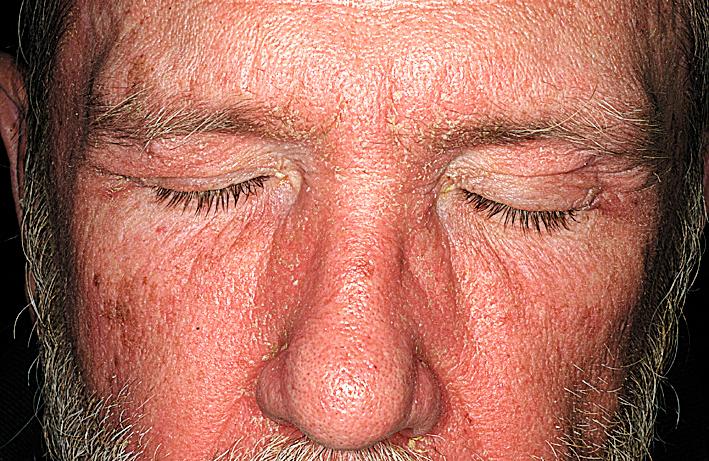 Fig. 5.42, Seborrheic dermatitis. Active disease in all of the characteristic areas. The inflammation cleared with ketoconazole cream.