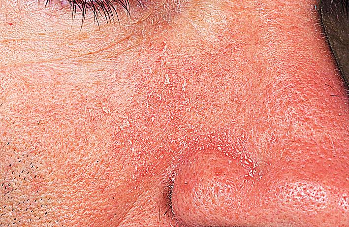 Fig. 5.43, Seborrheic dermatitis. A classical presentation for seborrheic dermatitis. Ketoconazole cream failed. A 7-day course of a group V topical steroid was effective. The patient was warned not to use topical steroids continuously on the face.