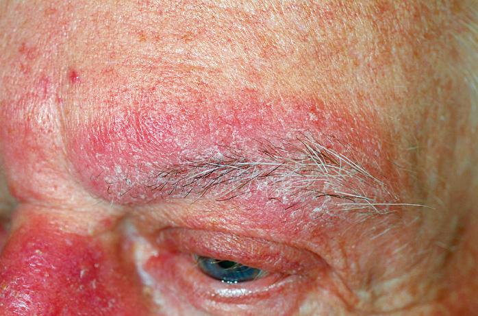 Fig. 5.45, Seborrheic dermatitis. Inflammation is more obvious than scaling in this patient with eyebrow involvement. Topical ketoconazole and intermittent topical desonide lotion will likely control this seasonal flare.