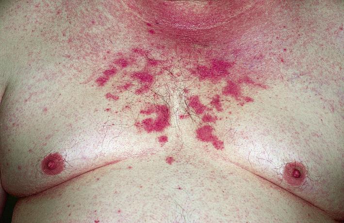 Fig. 5.46, Seborrheic dermatitis. Presternal faint plaques with thin, moist scale typical of a summertime flare.