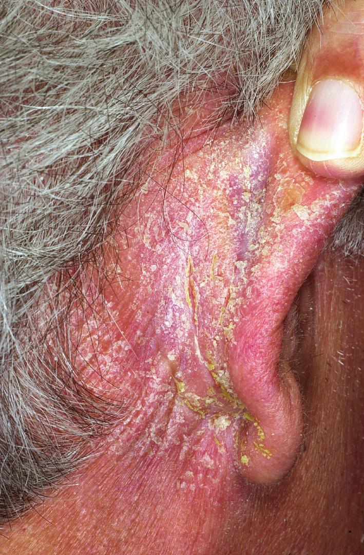 Fig. 5.47, Seborrheic dermatitis. Postauricular involvement may be difficult to discern from psoriasis. In addition to shampoos, desonide lotion will control the itching and scaling.