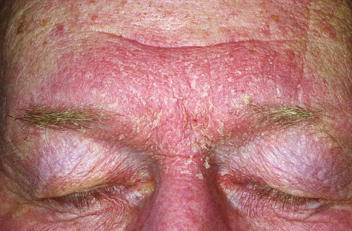 Fig. 5.48, Seborrheic dermatitis. Glabellar involvement with transparent scaling responds to daily washing with ZNP bar and intermittent use of group VI or VII topical steroid.