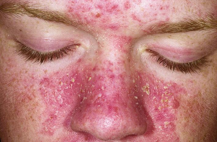 Fig. 5.49, Seborrheic dermatitis. Erythema with more adherent greasy scale in this adolescent patient may require twice-daily washing and topical antifungal cream.