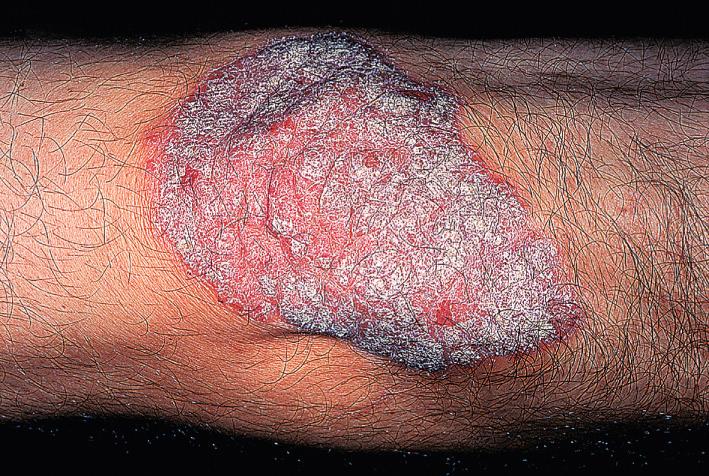 Fig. 5.5, Plaque psoriasis: the classical presentation. The thick red plaques have a sharply defined border and an adherent silvery scale.