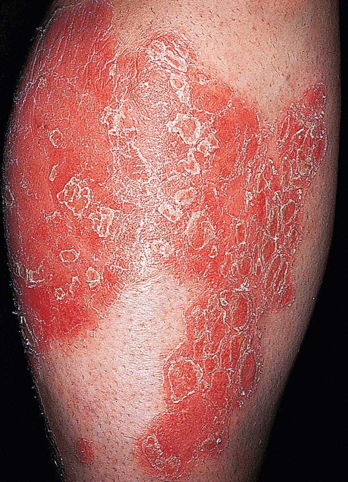 Fig. 5.6, Plaque psoriasis. Plaques may become red and inflamed. Inflamed plaques need to be treated carefully with topical medication. All topical medications, except topical steroids, can aggravate these active lesions.