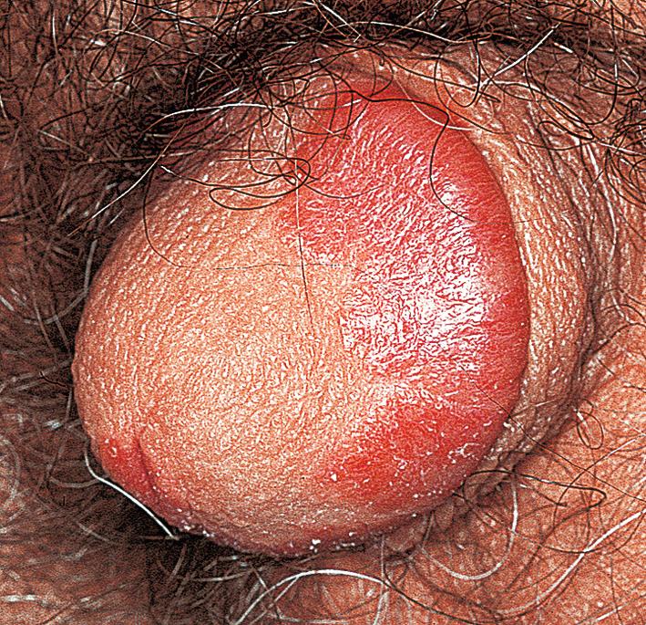 Fig. 5.7, Plaque psoriasis. A fixed red plaque with a sharp border on the glans is a common presentation for psoriasis. It may be the only cutaneous lesion. The plaques often last for months and years. Topical steroids provide temporary relief but should not be used constantly. Most other topical medications are too irritating. Patients should be reassured that this disease is not contagious. Patients often misinterpret this disease as a yeast infection.