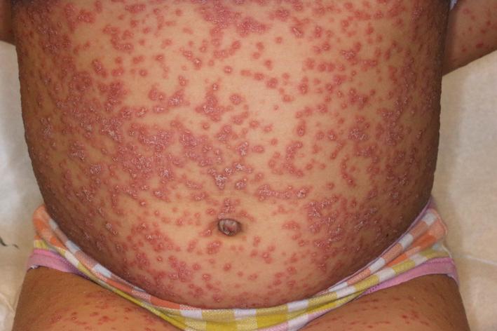 Fig. 5.8, Guttate psoriasis. Sudden appearance of numerous monomorphic psoriasis papules on the trunk is often triggered by streptococcal infection, particularly in children, adolescents, and young adults without prior history of psoriasis.