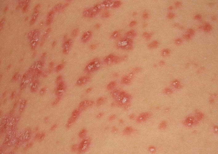 Fig. 5.9, Guttate psoriasis. Closer inspection confirms guttate psoriasis and reveals firmly adherent white scale.