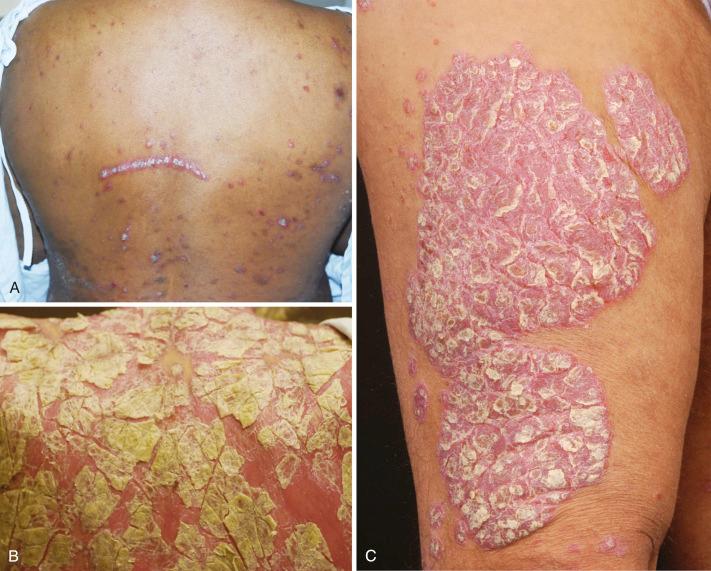 FIGURE 6-1, Chronic plaque psoriasis/psoriasis vulgaris. A, Photo on upper left shows Koebner response after scratching. B, Photo on lower left shows extensive chronic plaque psoriasis involving the entire back. C, Typical psoriasis plaques with overlying silvery white scale on an erythematous background sharply demarcated from normal skin.