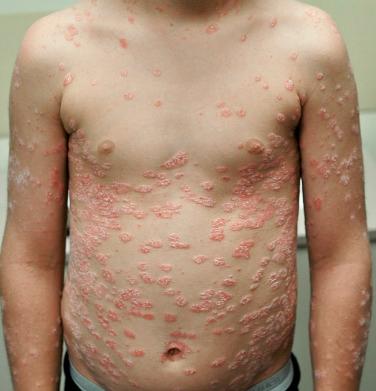 FIGURE 6-2, Guttate psoriasis in a young child following a strep infection.