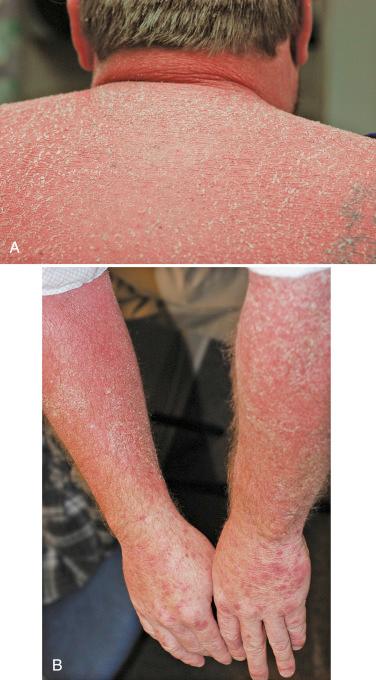 FIGURE 6-3, Erythrodermic psoriasis. A, Extensive erythema is the most prominent sign as can be seen in this photo from the upper back of an erythrodermic patient, and scaling is typically much finer than what is seen in plaque psoriasis. B, Erythrodermic psoriasis is more diffuse in nature and characteristically lacks the sharp demarcation from normal skin as can be seen in this photograph of the arms from the same case as in ( A ).