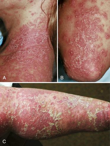 FIGURE 6-4, Pustular psoriasis. Extensive eruption of pustular psoriasis of the neck ( A ) and elbow ( B ) in a young female. When pustular psoriasis resolves it typically leaves behind erythematous background and peeling scale ( C ).