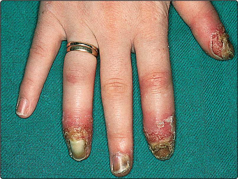 Fig. 18.3, Acrodermatitis continua variant of psoriasis.