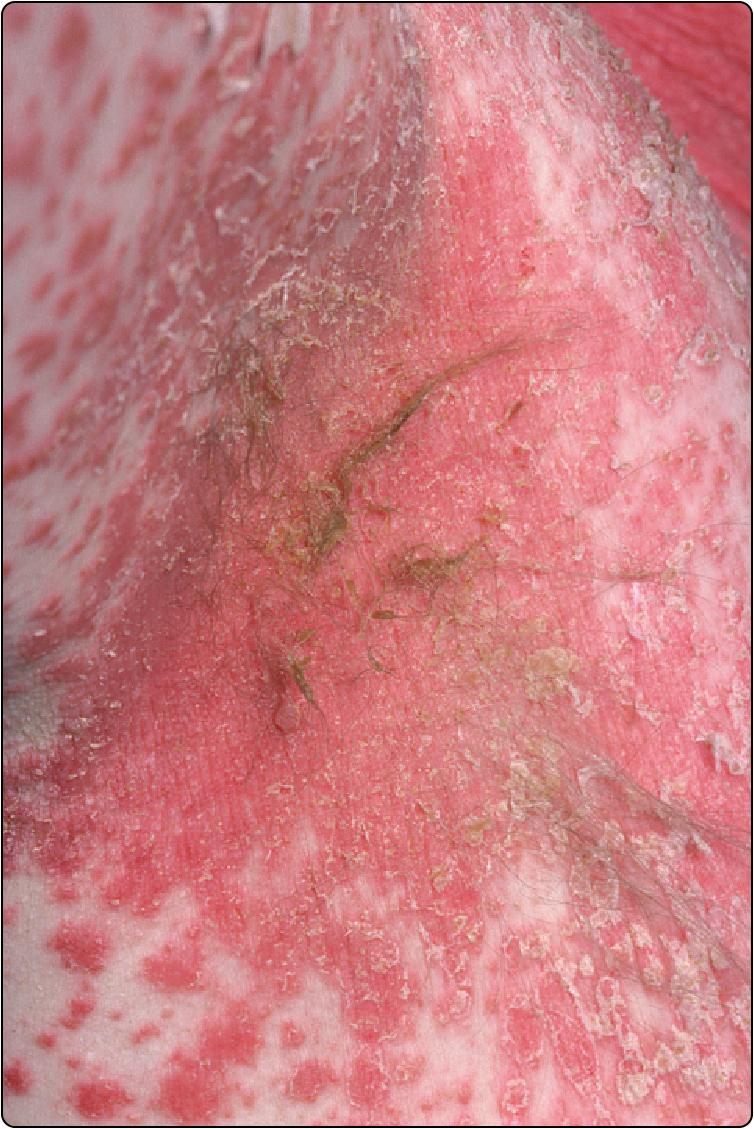 Fig. 17.1, Flexural psoriasis of the axilla showing erythematous plaques with scaling.