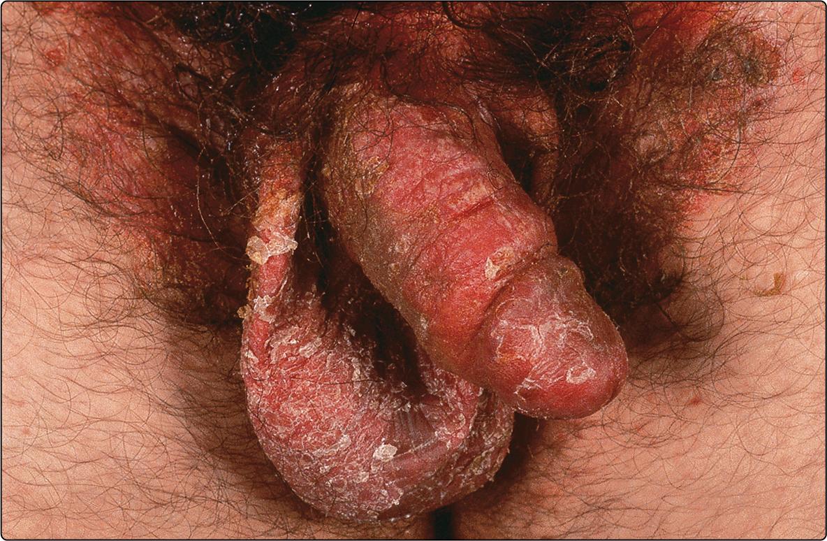 Fig. 17.2, Flexural psoriasis of the male genitalia.