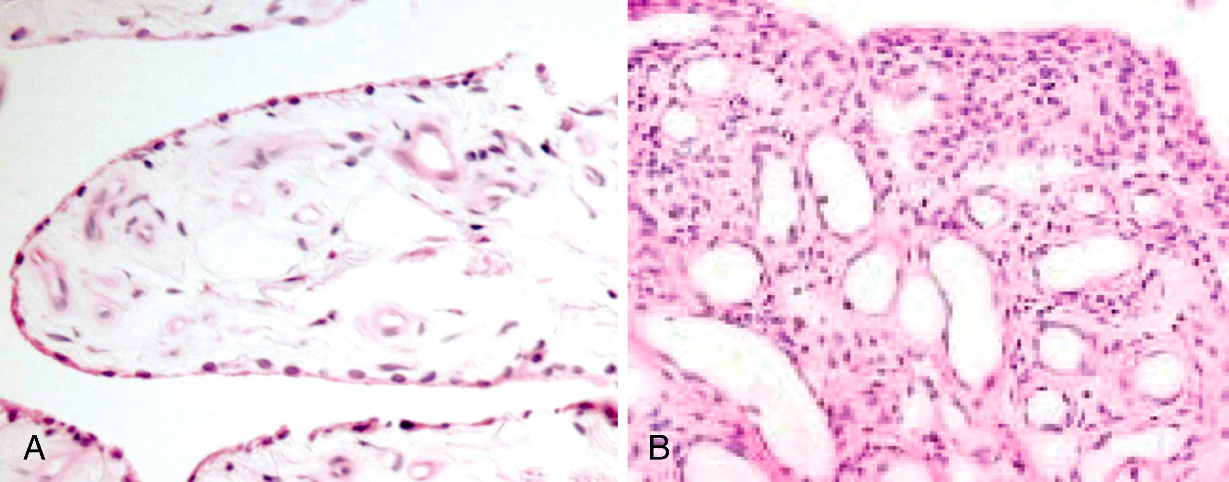 Fig. 21.2, Synovial pathology in juvenile psoriatic arthritis. A, Normal synovium with gracile synovial lining layer supported by a loose connective tissue sublining that contains small blood vessels. B, Synovium from a 35-year-old patient with juvenile-onset psoriatic arthritis, demonstrating lining hyperplasia, mononuclear infiltration of the subsynovium, and striking vascular hyperplasia.