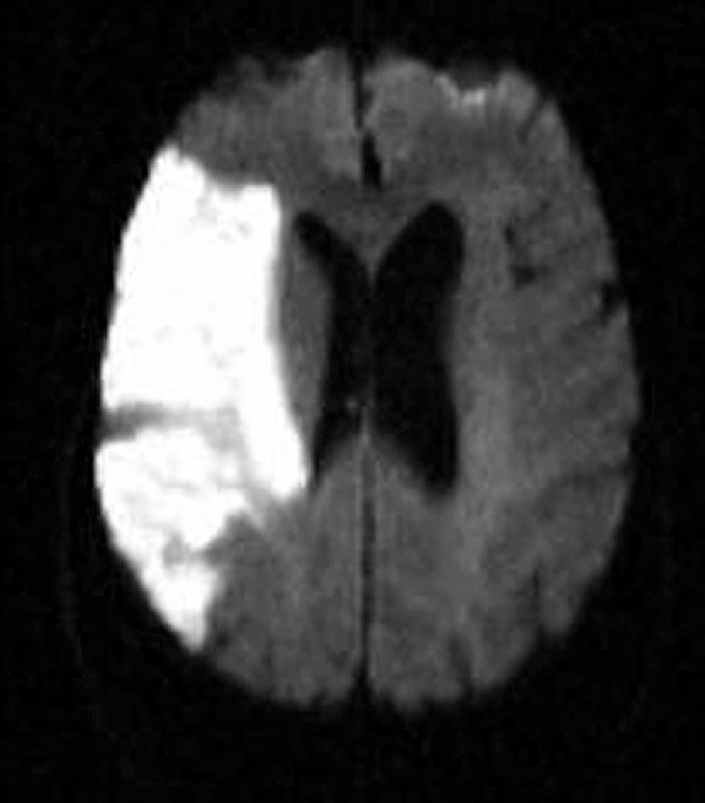 Figure 80-1, Diffusion-weighted MRI of a right middle cerebral artery territory infarct.