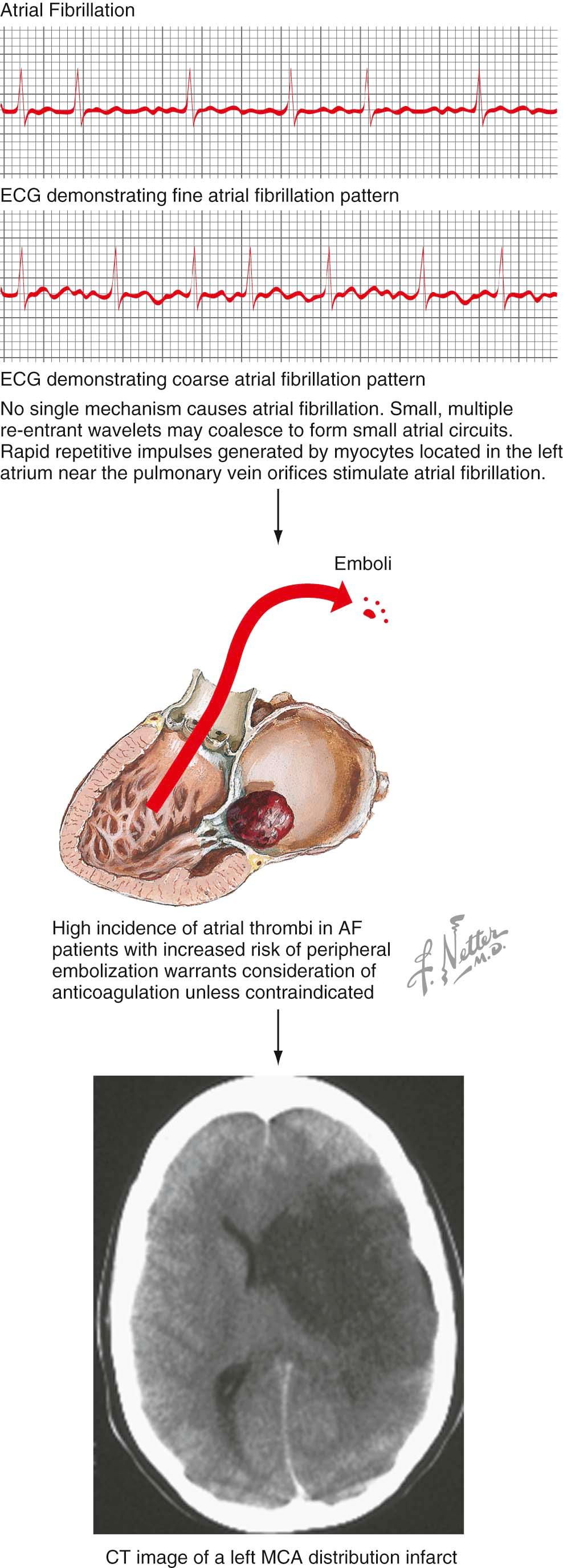 Figure 80-3, Cardioembolism leading to acute ischemic stroke.