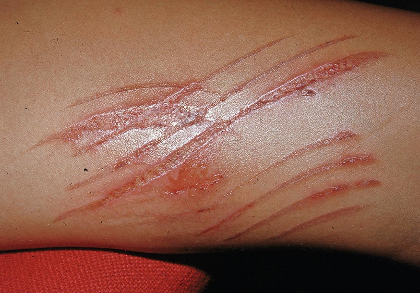 Fig. 67.1, Dermatitis artefacta presenting as linear lesions as the result of burns on the inner thigh of a young woman.