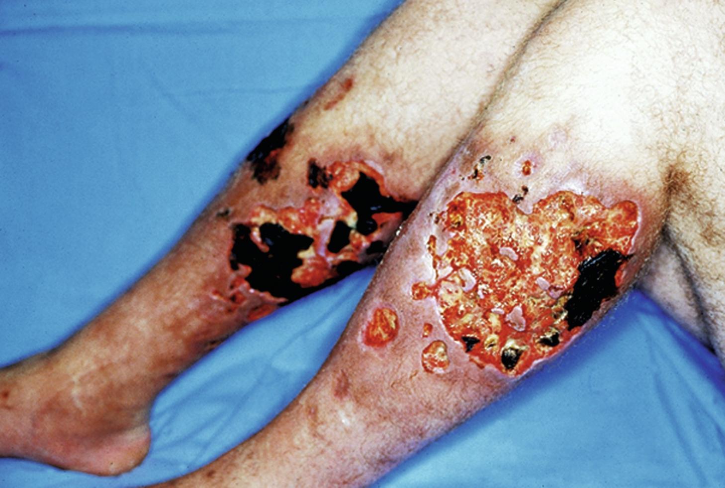 Fig. 67.2, Young man with factitial panniculitis. The patient was injecting unknown substances into his legs in an attempt to get doctors to provide him with narcotic agents.