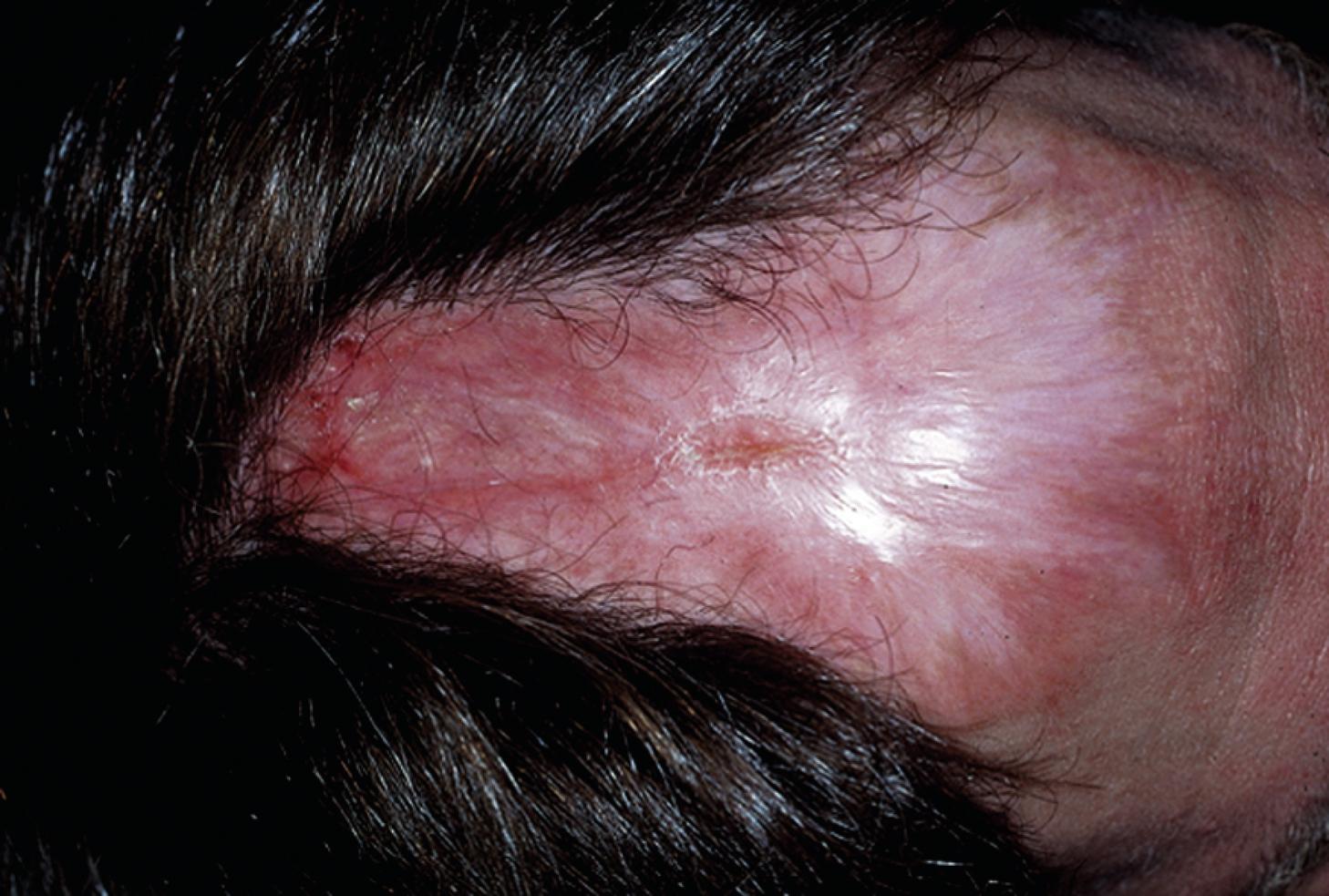 Fig. 67.3, Patient-induced ulceration and scars of the scalp.