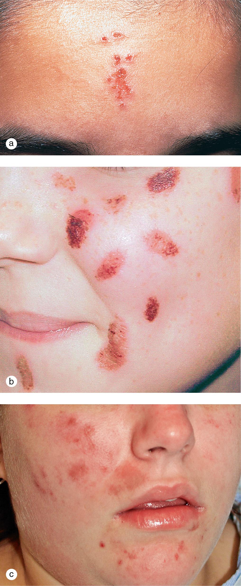 Fig 11.2, Acne excoriée. A 17-year-old girl compulsively picked at subtle comedones, which created punched out ulcerations on (a) her forehead. Another adolescent girl (b) and boy (c) manipulated lesions on their cheeks and chin.