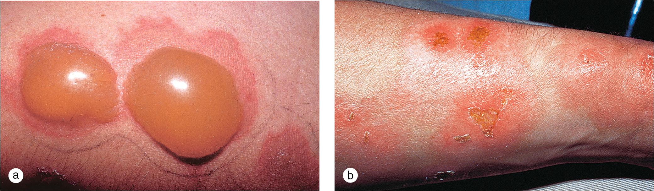 Fig 11.4, Factitial disorders. (a) A 15-year-old boy would periodically return from the woods behind his house with large, tense, bullous lesions on his arms. (b) Under close observation in the hospital, the lesions healed within several days. Later, in therapy, he admitted to applying a caustic liquid to the skin.