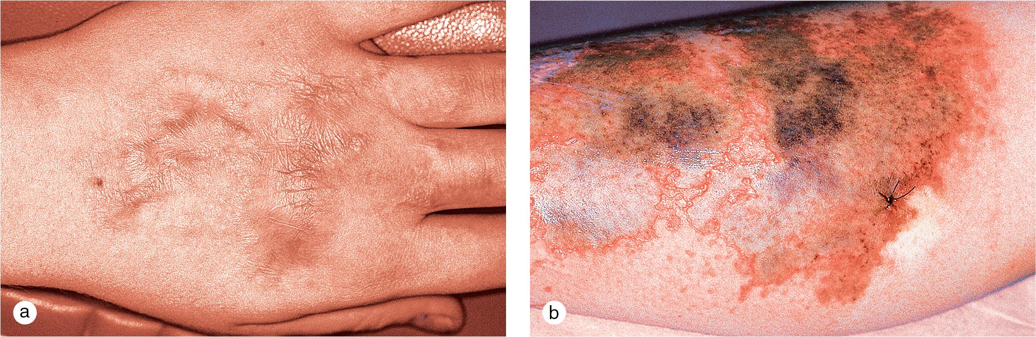 Fig 11.5, Factitial disorders. A 12-year-old girl has evidence of (a) old scarring and (b) new necrotic crusts on her leg from the application of a solvent to the skin. The fresh lesions healed under an occlusive dressing, which was left in place for 3 days.