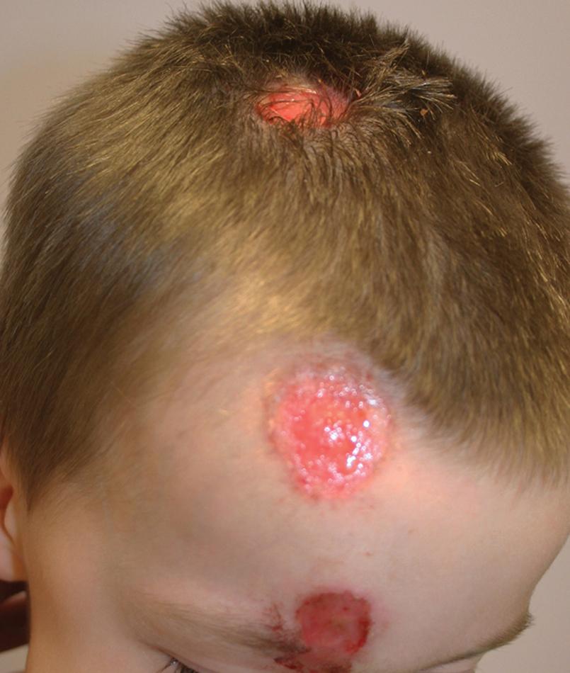 Fig 11.6, Trigeminal trophic syndrome. This 4-year-old boy with trigeminal trophic syndrome experienced intense focal pruritus just to the right of the midline of the scalp and forehead. He was noted to repeatedly scratch these areas.