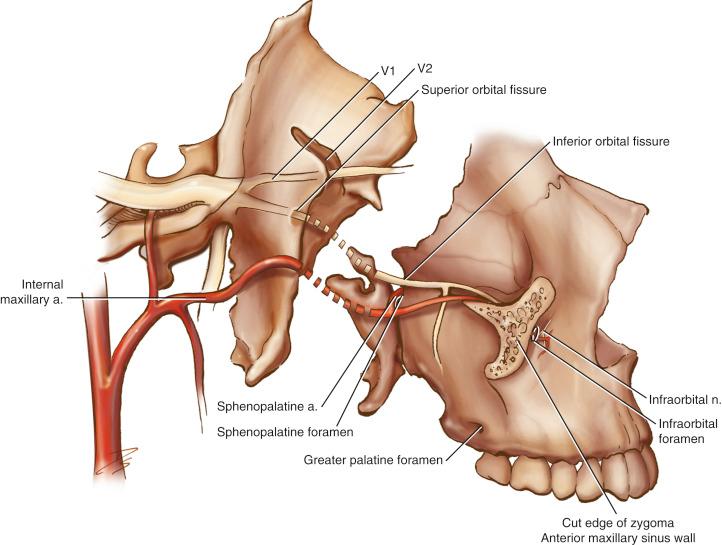 Fig. 24.1, Anatomic drawing showing the relationship of the pterygopalatine space to the adjacent sphenoid, maxillary, and palatine bones. Note the course of the maxillary artery and V 2 through the potential space, which can be enlarged by pathologic processes. a., Artery; n., nerve.