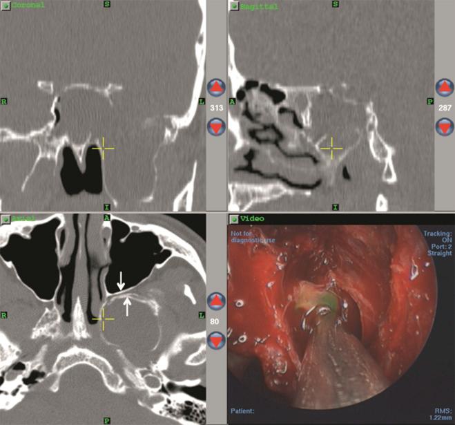 Fig. 24.2, Triplanar computed tomography (CT) images showing a large, complex lateral sphenoid recess meningoencephalocele splaying the pterygoid plates. The endoscopic view (lower right) reveals the fluorescein-stained sac, which has been exposed by removal of the posterior wall of the maxillary sinus and bone of the pterygoid root. These bony layers are indicated by white arrows on the axial CT image (lower left).