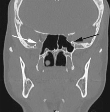 Fig. 24.3, Coronal computed tomography (CT) sinus scan showing a right schwannoma involving the enlarged foramen rotundum (white arrow). The black arrow denotes a normal-appearing foramen rotundum.