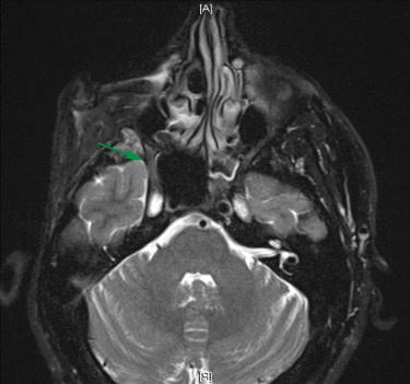 Fig. 24.4, Axial T2-weighted magnetic resonance image (MRI) showing a right-sided adenoid cystic carcinoma involving V 2 (arrow) and traversing through inferior orbital fissure.