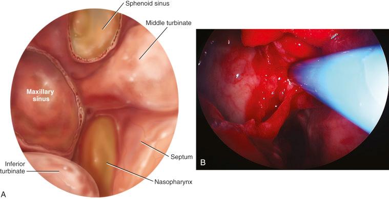 Fig. 24.5, Artist’s depiction in endoscopic view (A) and endoscopic photograph (B) of a widely opened maxillary sinus, with attachment of the middle turbinate posteriorly. The medial wall of the maxillary sinus should be resected to the orbital process of the palatine bone.