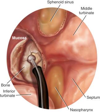 Fig. 24.6, Artist’s depiction (in endoscopic view) of reflection of the mucosa of the posterior wall of the maxillary sinus and use of a suction irrigation drill to thin the wall. The posterior wall of the maxillary sinus is thinned until the fascia of the pterygopalatine fossa is encountered.