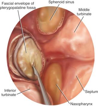 Fig. 24.7, Artist’s depiction of incision of the fascia of the pterygopalatine fossa in endoscopic view. Great care should be used when incising the fascia, because the maxillary artery can be easily injured.