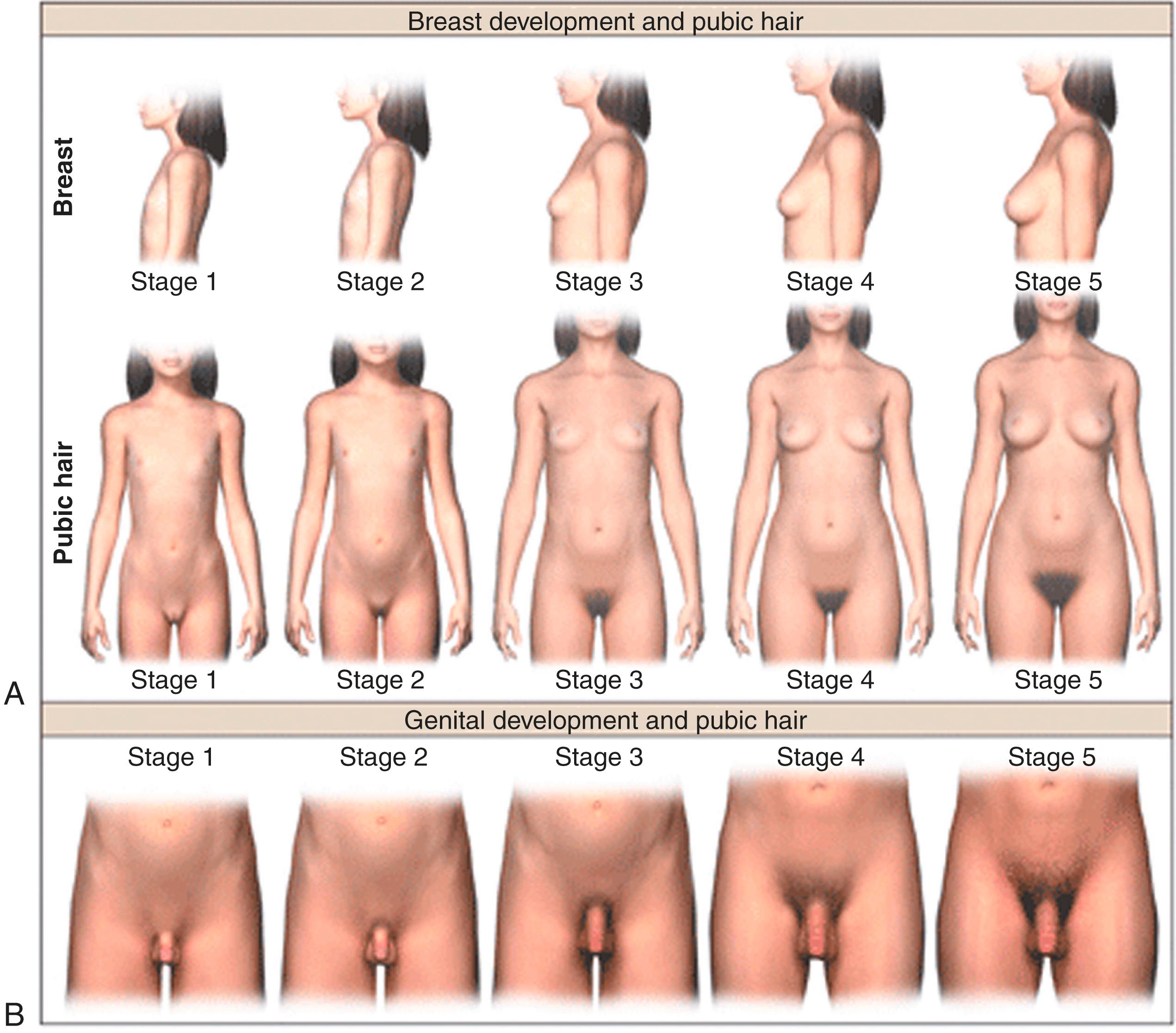 Fig. 18.1, Pubertal rating according to Tanner stages.